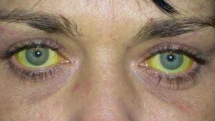 Молдова на первом месте в мире по числу больных гепатитом