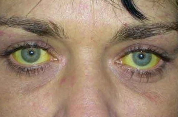 Молдова на первом месте в мире по числу больных гепатитом